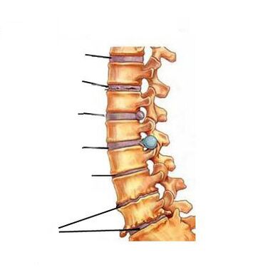 Osteokondroz nasıl gelişir
