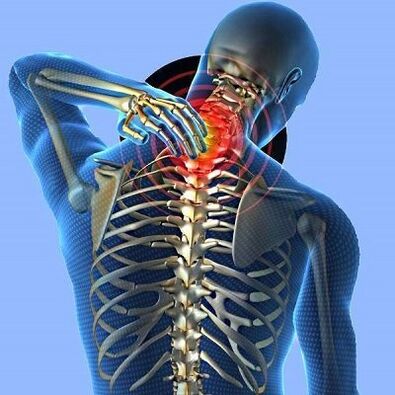 Servikal osteokondroz ile boyun ağrısı