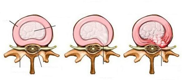 Servikal osteokondroz ile intervertebral fıtık