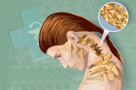 Osteokondroz refleks semptomları